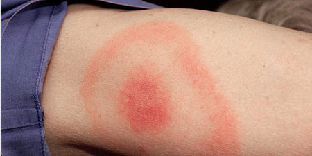 The classic Lyme disease bullseye (Wikimedia)